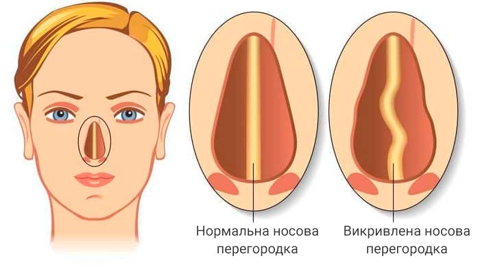 Ендоскопічна септопластика у медичному центрі Еліт
